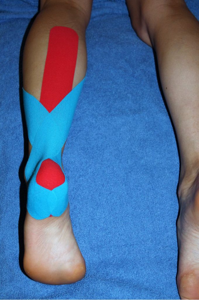 Achilles taping for runners